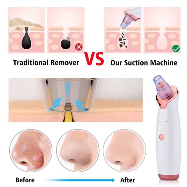 blackhead remover usage